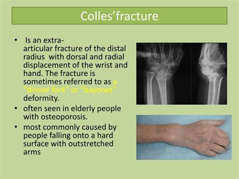 dating fractures in adults